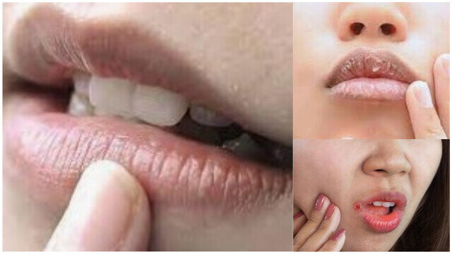 গরমে ঠোঁট ফাটার কারণ ও প্রতিকার