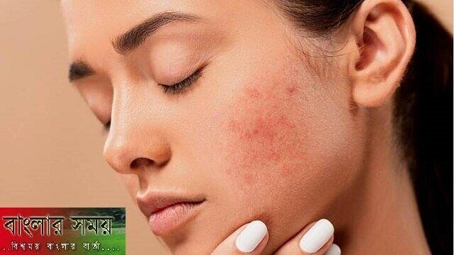 গরম এলেই গায়ে ব্রণের মতো হয়, কেন